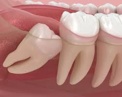 Healthy wisdom teeth growing properly