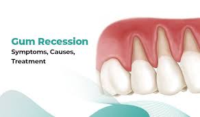 Patient showing signs of gum recession and exposed tooth roots