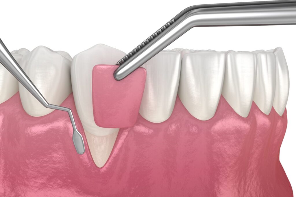 Gum graft procedure used to treat receding gums