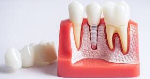 Wisdom teeth comparison between impacted and normal growth