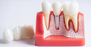 Wisdom teeth comparison between impacted and normal growth
