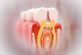 Bone resorption after tooth extraction