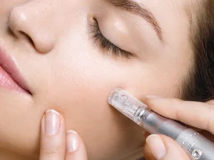 microneedling treatment des plaines il bright dental