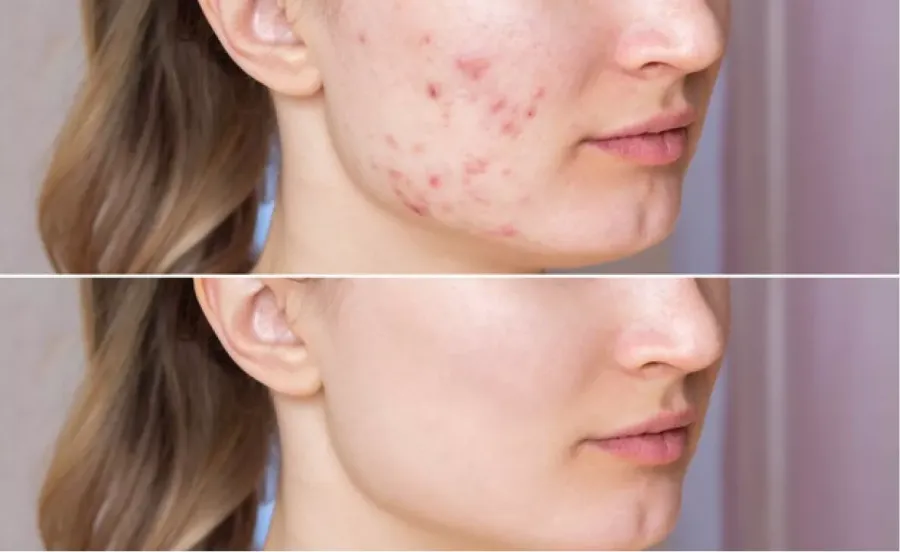 skin rejuvenation des plaines il