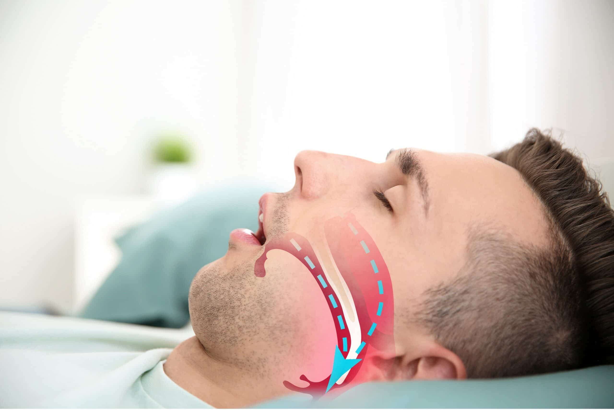 Patient sleeping with symptoms of obstructive sleep apnea