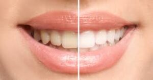 teeth whitening in des plaines il bright dental