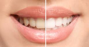 teeth whitening in des plaines il bright dental