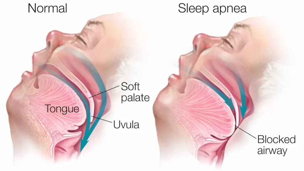 Diagram showing airway blockage during sleep apnea